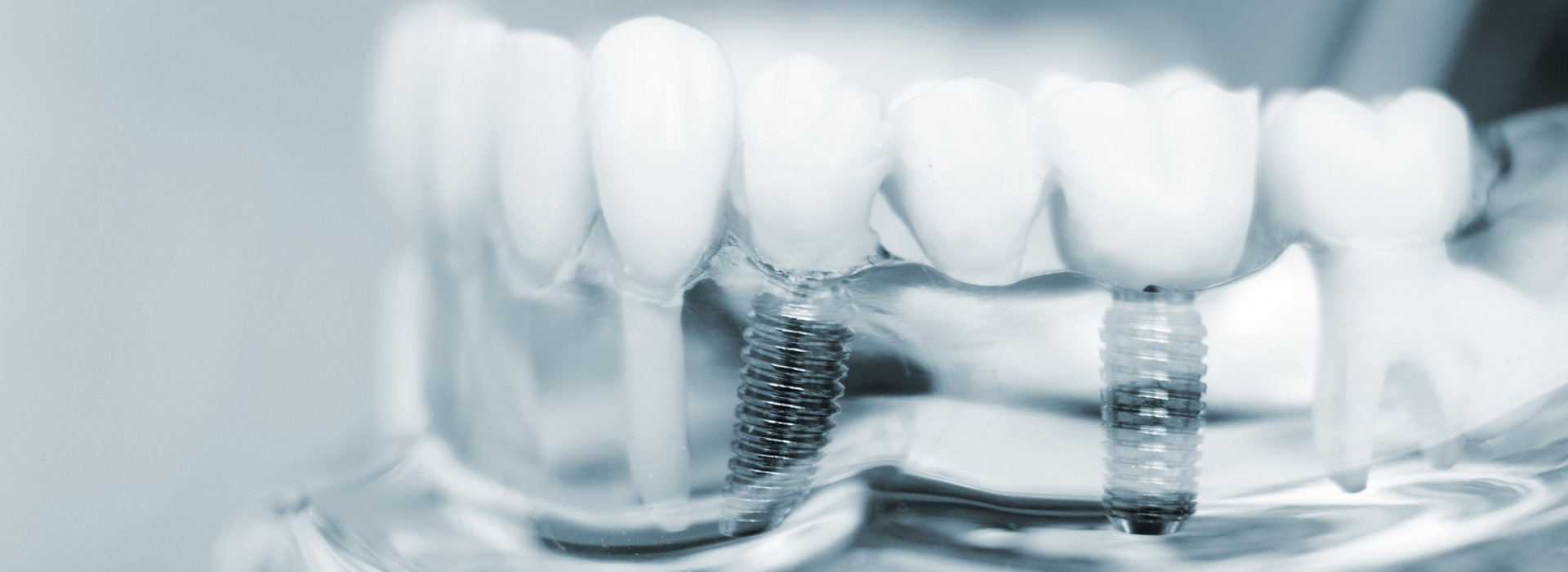 Kennedy Dentistry | Fluoride Treatment, Implant Dentistry and Dental Sealants